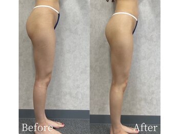 ミスティア(mistia)/エステ 脚1回