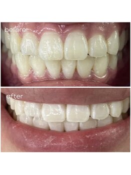 エクシアホワイトニング 津駅前店/お客様ビフォーアフター