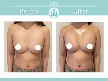 美人バスト 新潟店/ 【バストアップ★育乳】症例