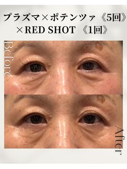 ネイルアンドアンチエイジングドゥシール(Docile)/60代女性｜目元脂肪・クマ改善