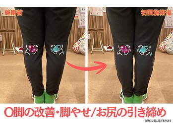 ニノ治療院(Nino治療院)の写真/O脚改善・お尻・太もものサイズダウンしたい女性にオススメ！
