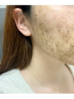 アンベリィ ネイル(embellie nail)/ハーブピーリング