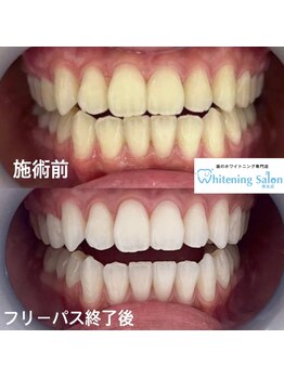 ホワイトニングサロン 熊本店/簡単セルフホワイトニング