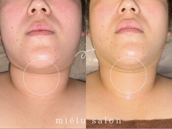 ミエル(mielu)/小顔矯正×キャビテーション