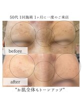 リノ(Lino)/シミケア1回の変化