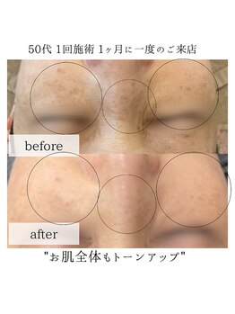 リノ(Lino)/シミケア1回の変化