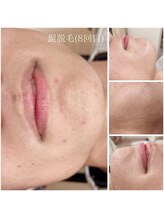 ミイン 宮代(MIIN)/髭脱毛8回目