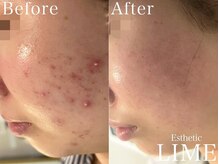 ベル 赤羽(Belle)/ハーブピーリング｜ニキビケア