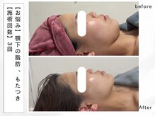 レッド(RED)/顎下の脂肪も分解☆小顔術