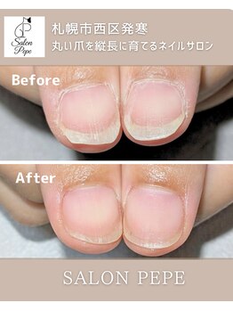 自爪育成で育てた親指