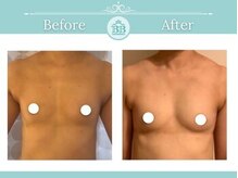 美人バスト 新潟店/ 【バストアップ★育乳】症例