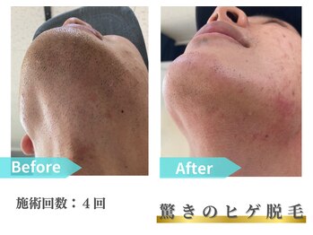 トレース/ヒゲ脱毛の効果