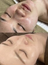 レイ(Lei)/頑固なニキビケア★