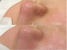 アクアカイロプラクティック/ハイドロスプラッシュ☆毛穴洗浄