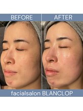 ブランロップ(BLANC LOP)/【ハーブ】内側から輝く白玉肌へ