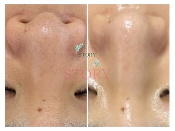 ストーリー(STORY)/眉毛と艶肌ワックス専門店