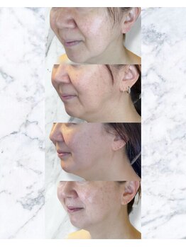 ルミライ(Lumirai)/たるみ改善|毛穴|フェイシャル