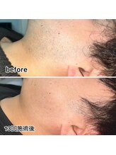 リル(RILU)/髭【脱毛】男性(before・after)