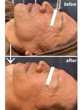 ルアナ(Luana)/【リピートNO.1】WiQo＆光フォト