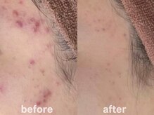 ホワイトアクア 鹿児島店(WHITE AQUA)/ハーブピーリング8ヶ月/肌質改善