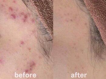 ホワイトアクア 鹿児島店(WHITE AQUA)/ハーブピーリング8ヶ月/肌質改善