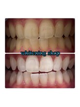 ホワイトニングショップ 大阪玉造店/Before&After美白ホワイトニング