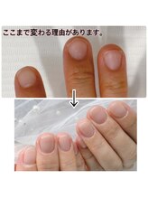 パールズ(PEARLS)/美爪改善ビフォーアフター(６回)