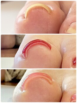 爪の悩みを解消できる（ケア含む）