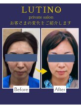 ルチノ(LUTINO)/美白コース40代6回