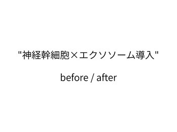 トモニ(TOMONI)/神経幹細胞×エクソソーム導入