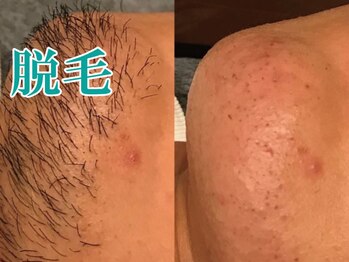 美宝 元町/男性。ヒゲ脱毛