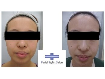 フェイシャルスタイリストサロン 高崎店(Facial Stylist Salon)/ケア例(37)