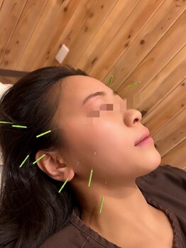 二和まんぷく整骨院鍼灸院/美容鍼