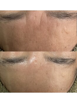 アディ(Adiy)/ビフォーアフター