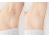 【レディース★】ワキ脱毛4,500円⇒600円
