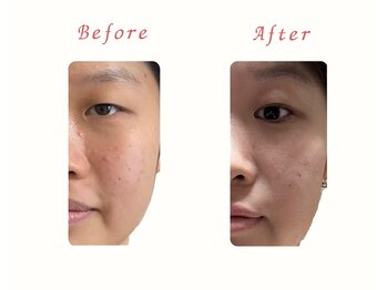 ヨサパーク リノ(YOSA PARK Lino)/Before/After［痩身/リンパ］