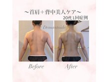 デマントイド(Demantoide&Co)/1回60分！背中美人痩身ケア
