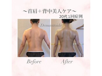 デマントイド(Demantoide&Co)/1回60分！背中美人痩身ケア