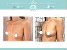 美人バスト 新潟店/ 【バストアップ★育乳】症例