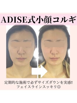 アディス 心斎橋店(ADISE)/定期的な施術で必ず変わる！