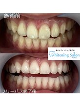 ホワイトニングサロン 熊本店/学生にもセルフホワイトニング