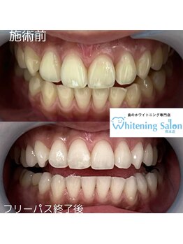 ホワイトニングサロン 熊本店/学生にもセルフホワイトニング