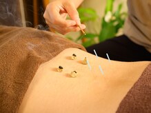 ととろはりきゅう院/筋肉の張り、筋肉痛、をとるお灸