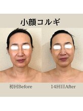 リーブル(LIBRE)/小顔コルギ　１年での変化