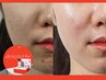 【6月8～20日限定】ララピールで美白、トラブル肌改善！韓国女優肌へ9000円→