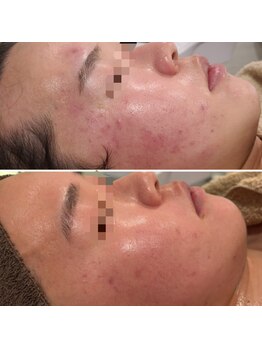 シス(SiS.)/月1×5回目のハーブピーリング