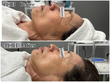 エミマス ボーテ(Emimas Beaute’)/６０代　小顔矯正＆幹細胞４回目