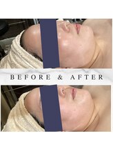 肌イズム 守谷店(肌ism)/【before&after】レモンボトル