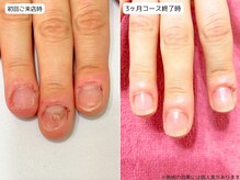 カピリナ(Ka Pilina)/自爪育成・深爪・川崎