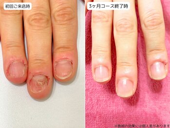 カピリナ(Ka Pilina)/自爪育成・深爪・川崎